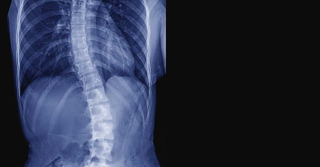 X-ray image of teenager patient spine show Scoliosis and spinal bend in young people.