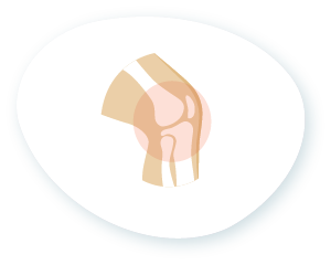 Grafik zeigt ein Knie mit Hinweis auf Verletzung